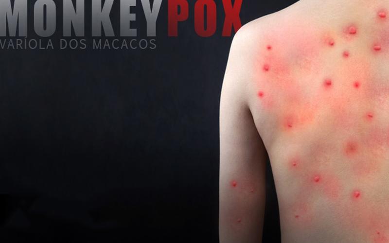 Arte: Contraf/CUT Imagem de uma pessoas com as feridas características da Varíola dos Macacos, em fundo preto, acompanhada da frase "Monkeypox - Varíola dos Macacos"