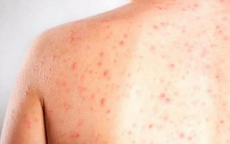 Sarampo é uma porta de entrada para ocorrer meningite e pneumonia Pixabay