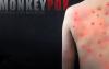 Imagem de uma pessoas com as feridas características da Varíola dos Macacos, em fundo preto, acompanhada da frase "Monkeypox - Varíola dos Macacos"